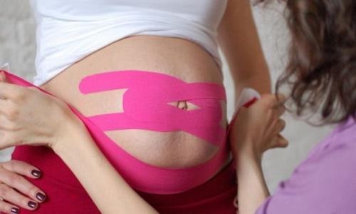 Кинезиотейпирование беременных